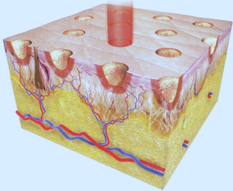 frakcyjna termoliza laserowa