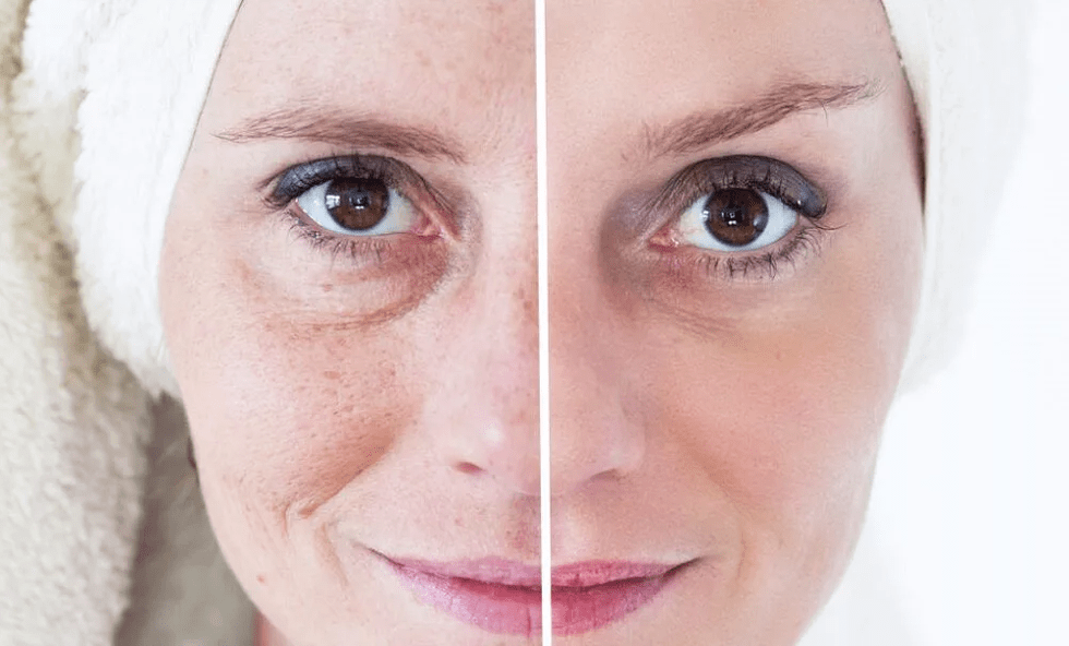 laserowe odmładzanie twarzy