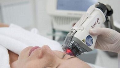 Jak przeprowadza się frakcyjne odmładzanie skóry